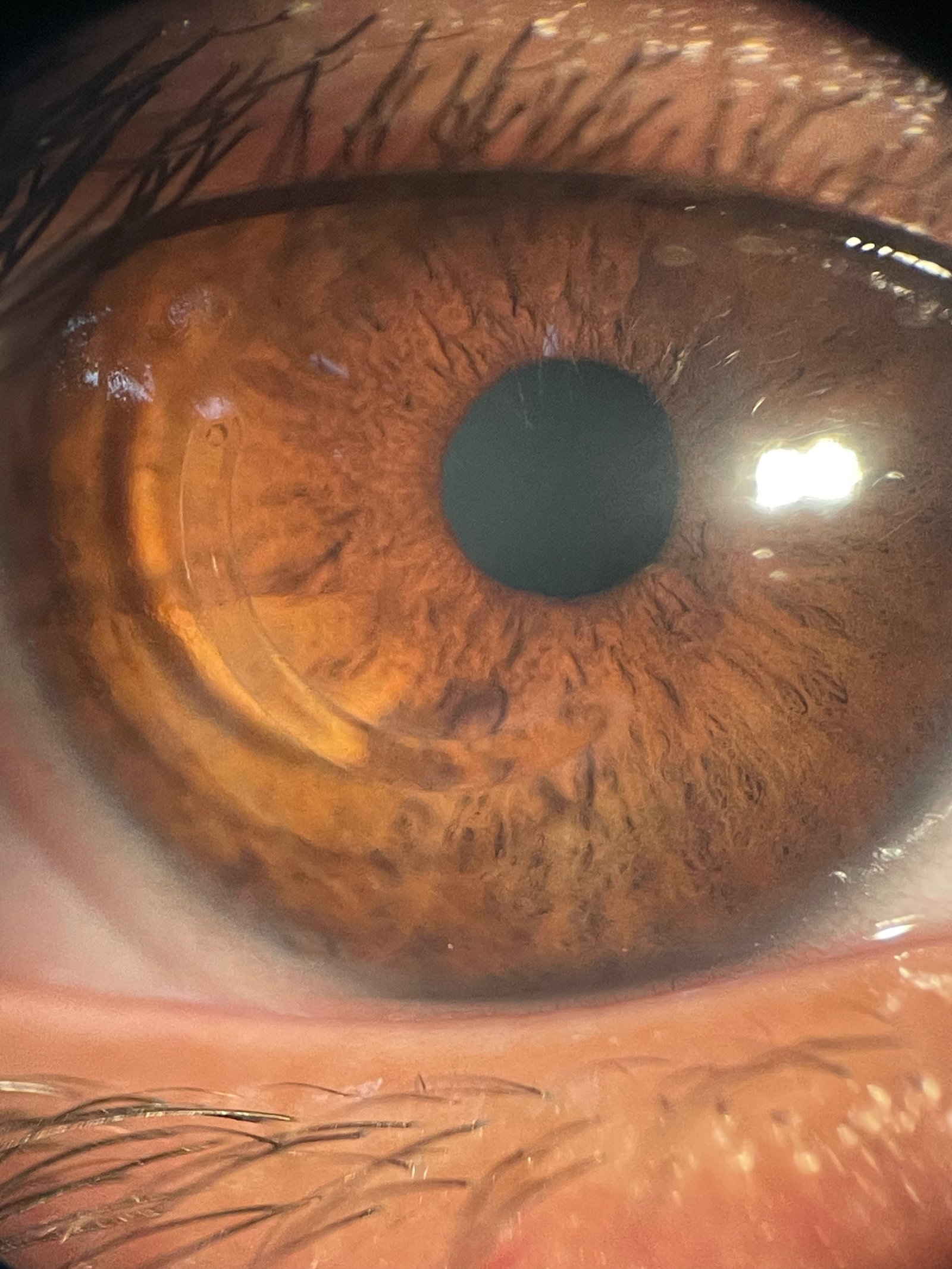 Anillo intraestromal implantado en córnea con queratocono — Guatemala