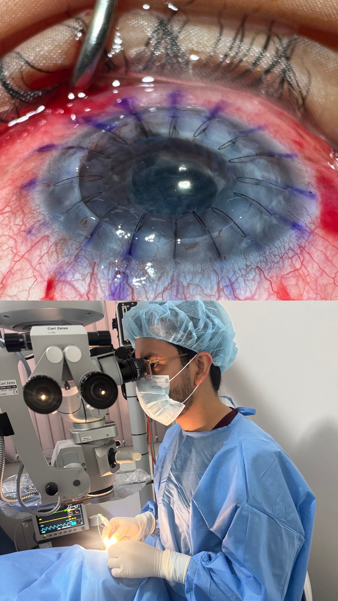 Dr. Bryan Gómez realizando trasplante de córnea penetrante en Guatemala