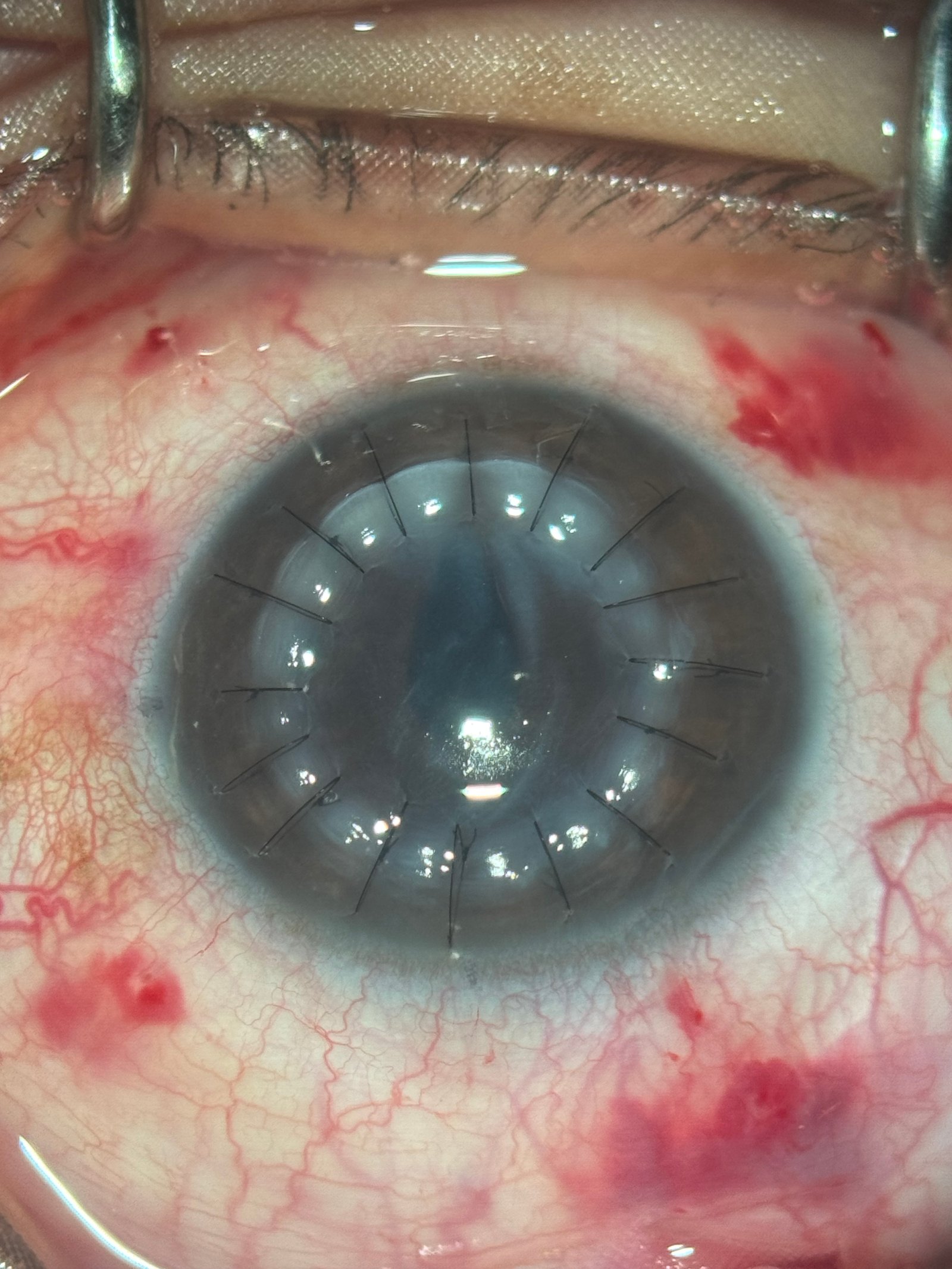 Córnea trasplantada con puntos de sutura — Queratoplastia penetrante Guatemala