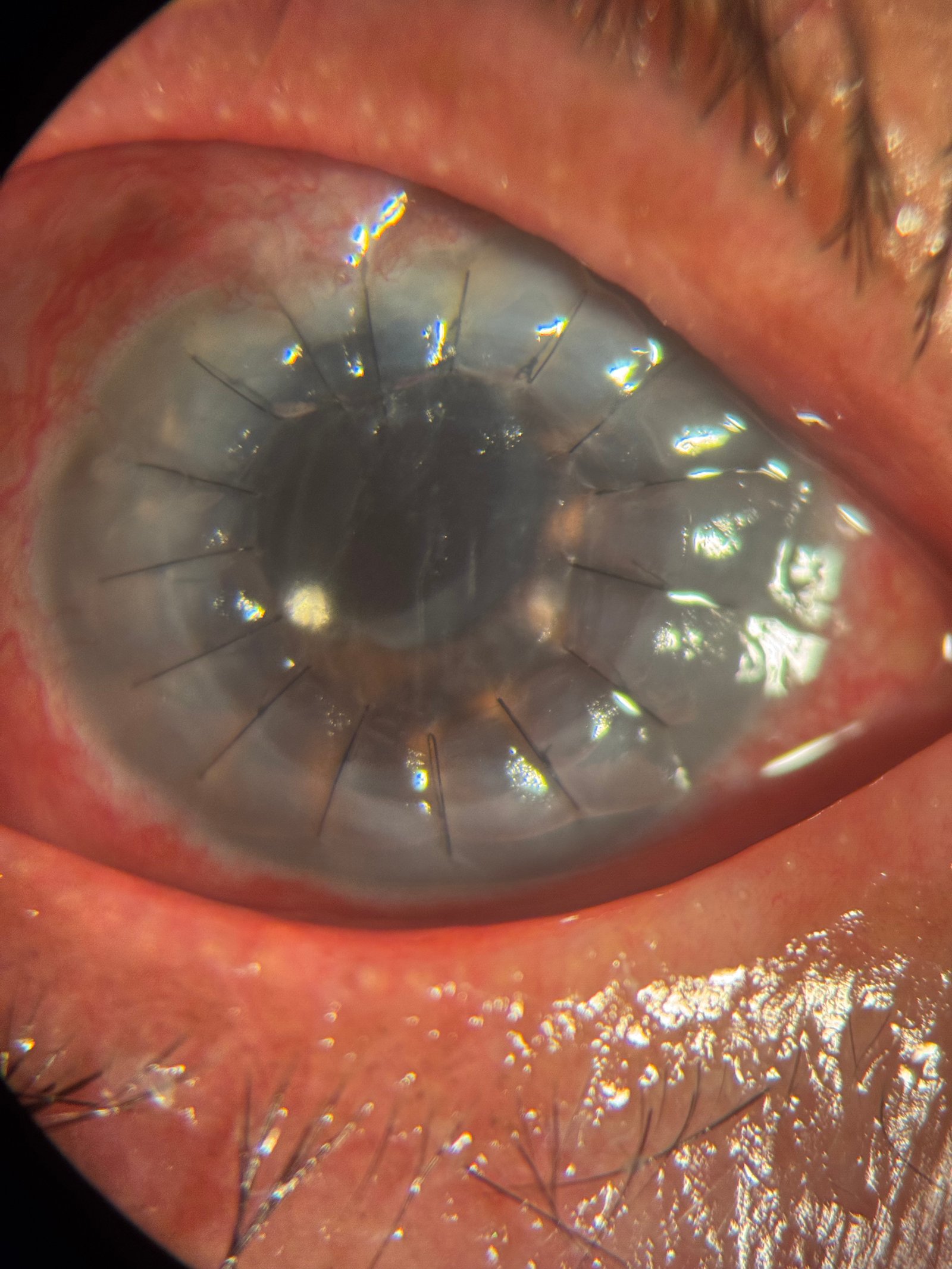 Queratoplastia penetrante puntos de nylon — Trasplante de córnea Guatemala